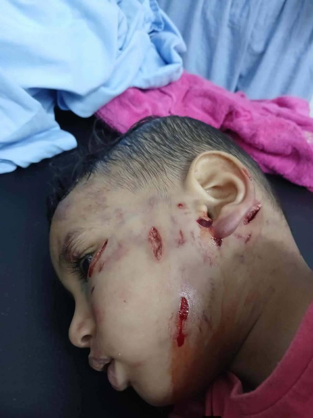 طفل طوخ ضحية الكلاب الضالة