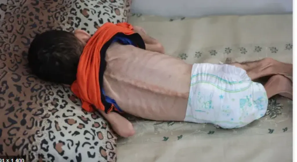 ضحايا الجوع في غزة يرتفعون.. 18 وفاة خلال 24 ساعة ومؤشرات على إبادة جماعية بالتجويع