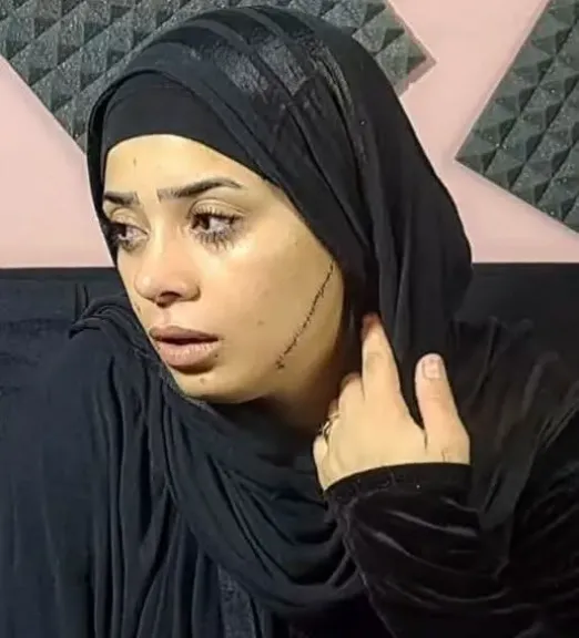 بسبب الغيرة  ...طليقة تشوه وجه عروس قبل ليلة زفافها