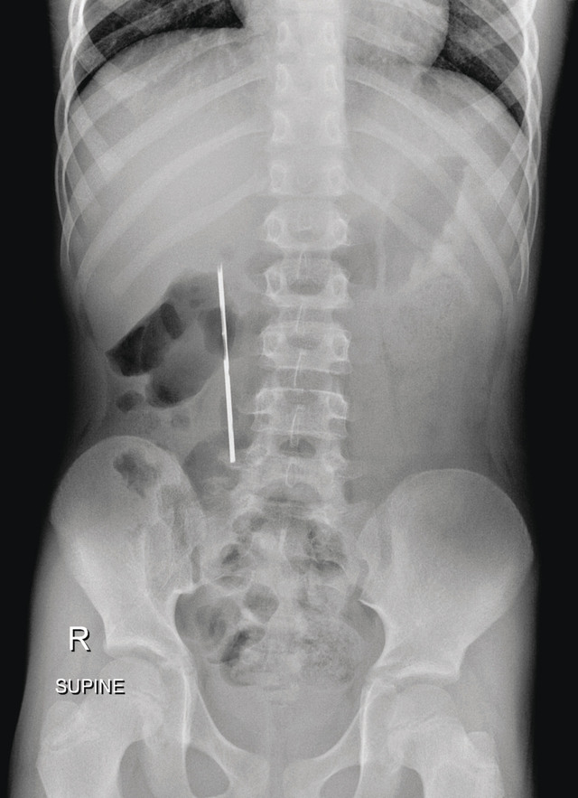 استخراج قطعة معدنية حادة من بطن طفل دون تدخل جراحي
