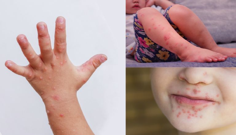 مرض اليد والقدم والفم
