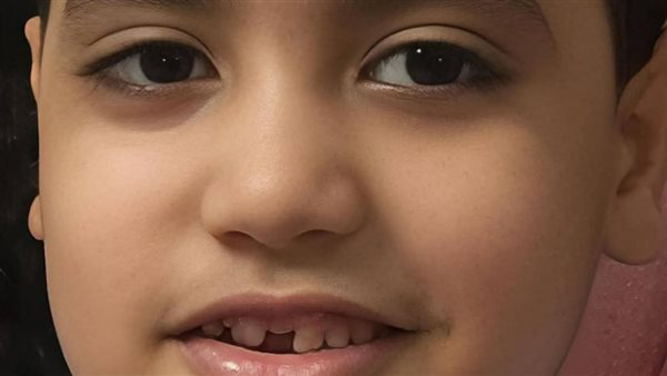 حادث مأساوي ببنها.. سقوط طفل وسط طاسة زيت ساخن أثناء شراء السحور