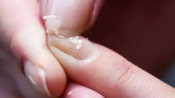 أعراض نقص الكالسيوم وكيفية التأكد منه.. علامات تستدعي الانتباه
