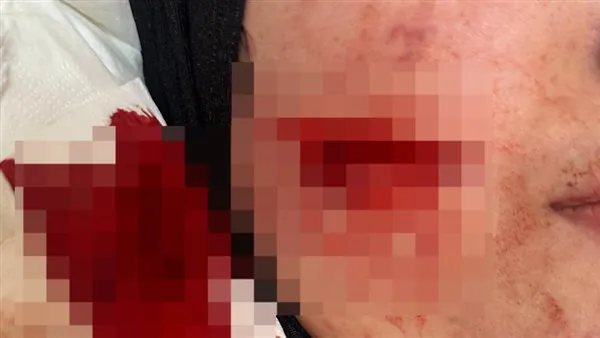 روان سعيد تتعرض لاعتداء مروّع بسكين من خطيبها السابق أمام جامعة الإسكندرية… وجرح قطعي في الوجه