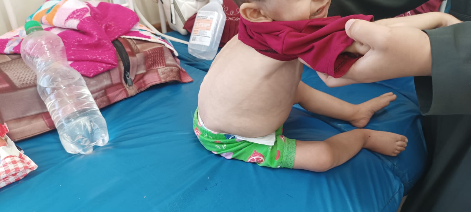 يحول أجسادًا لـ "هياكل عظمية" .. "سوء التغذية" يهدد حياة مئات الأطفال شمالي  قطاع غزَّة | فلسطين أون لاين