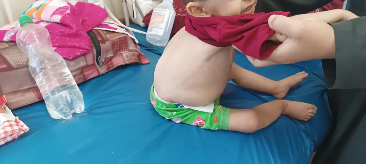 يحول أجسادًا لـ "هياكل عظمية" .. "سوء التغذية" يهدد حياة مئات الأطفال شمالي  قطاع غزَّة | فلسطين أون لاين